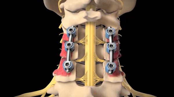 医疗医学脊椎脊柱手术三维3D